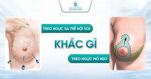Treo ngực sa trễ nội soi khác gì phương pháp treo ngực mỏ neo? So sánh chi tiết