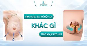 Treo ngực sa trễ nội soi khác gì phương pháp treo ngực kẹo mút? So sánh từ chuyên gia