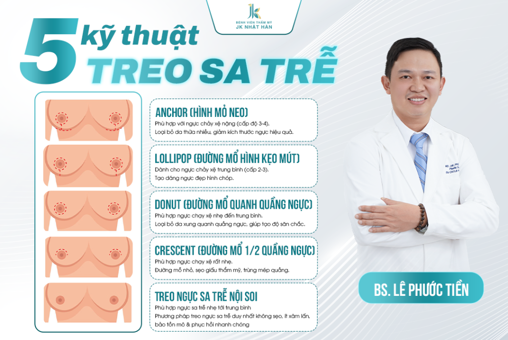 5 kỹ thuật treo sa trễ theo từng cấp độ sa trễ
