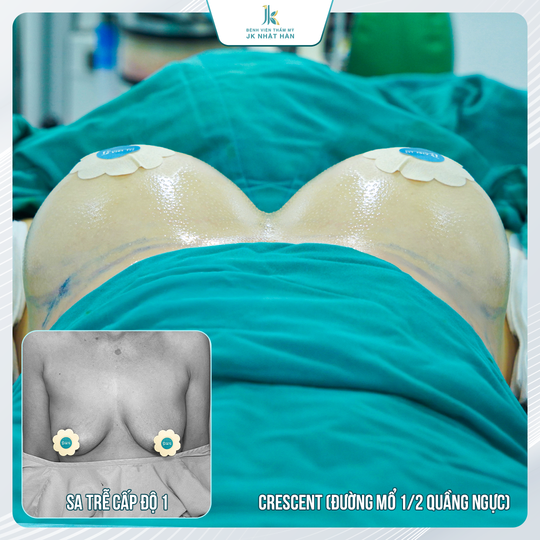 Treo ngực sa trễ nội soi khác gì phương pháp treo ngực lưỡi liềm?