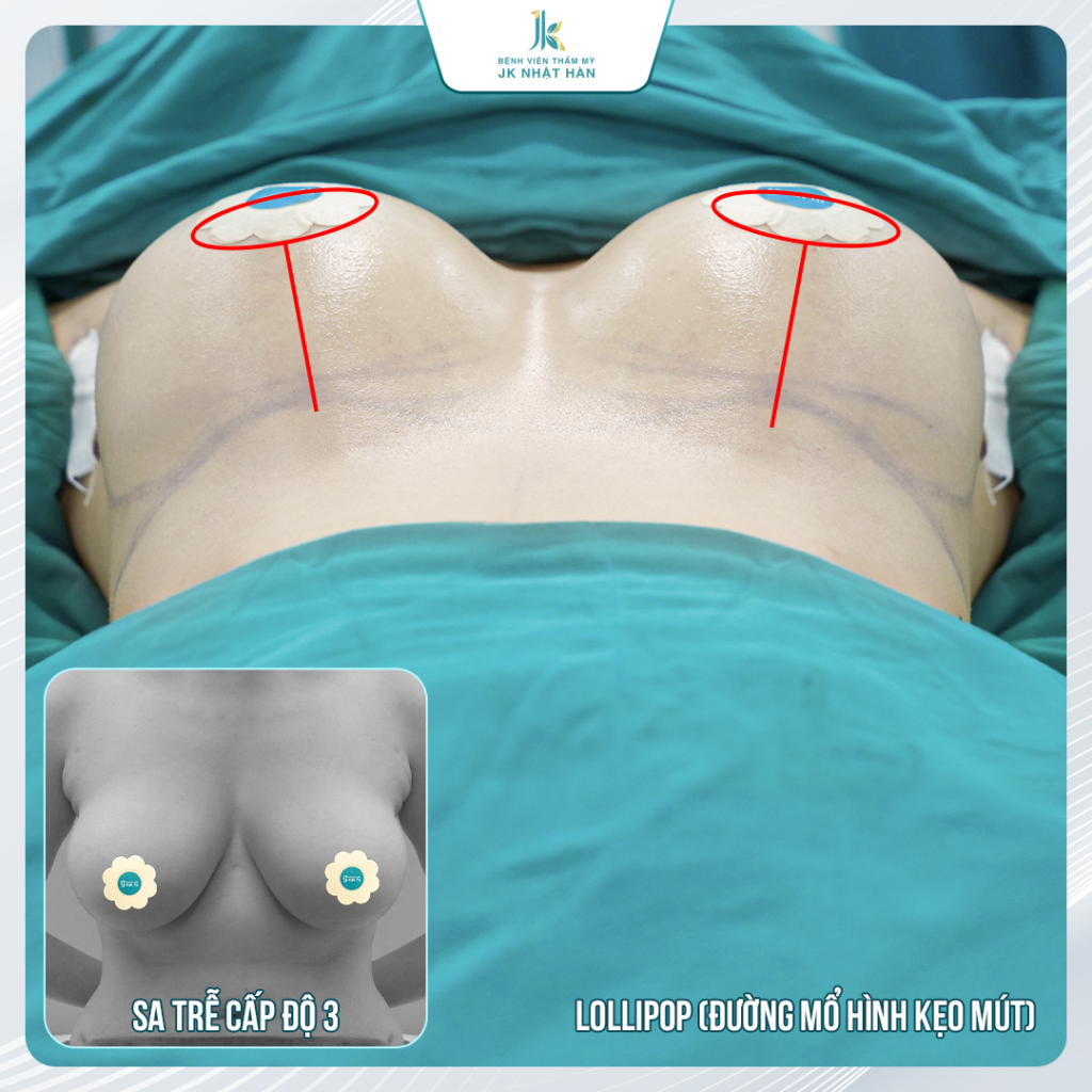 Treo ngực sa trễ nội soi khác gì phương pháp treo ngực kẹo mút?