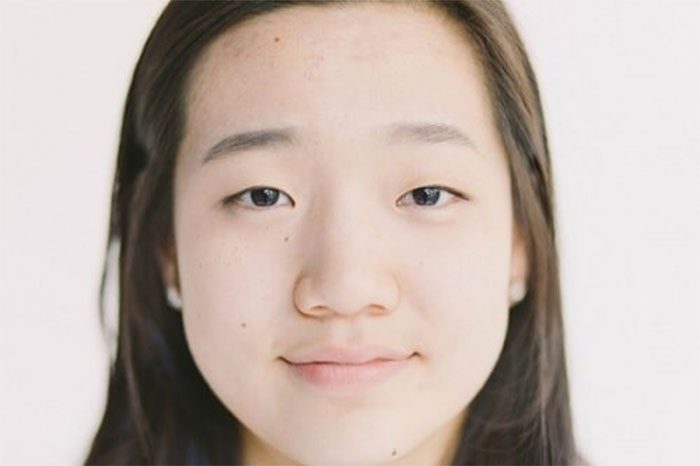 cánh mũi bị to và dày - JK Nhật Hàn