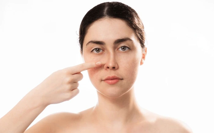 Sửa mũi hỏng do lệch