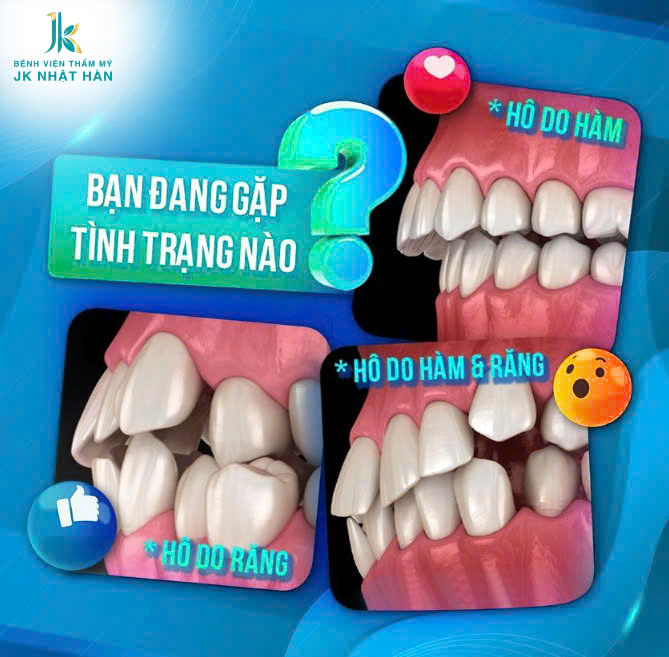 Phẫu thuật hàm hô là gì