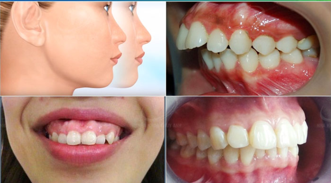 Khi nào cần phẫu thuật hàm hô?