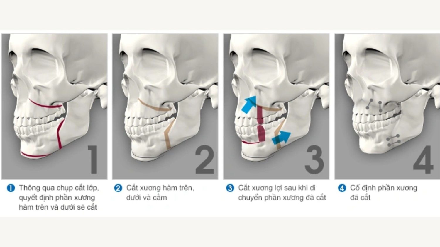 Hình ảnh mô tả quá trình khắc phục hàm hô
