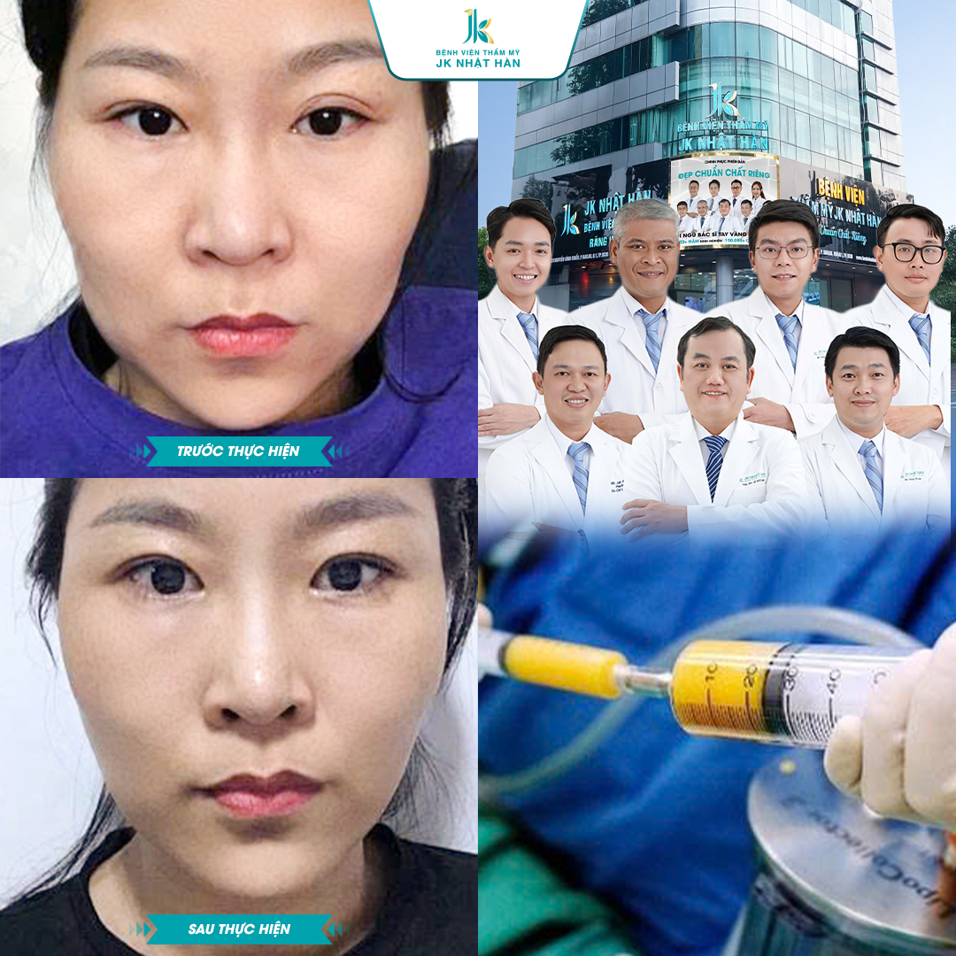 Cấy mỡ tự thân Nanofat là gì?