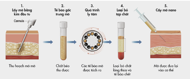 Quy trình cấy mỡ tự thân Nanofat chuẩn y khoa tại JK Nhật Hàn