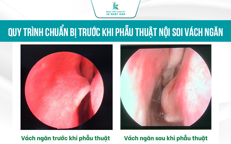 Quy trình chuẩn bị khi mổ nội soi vách ngăn