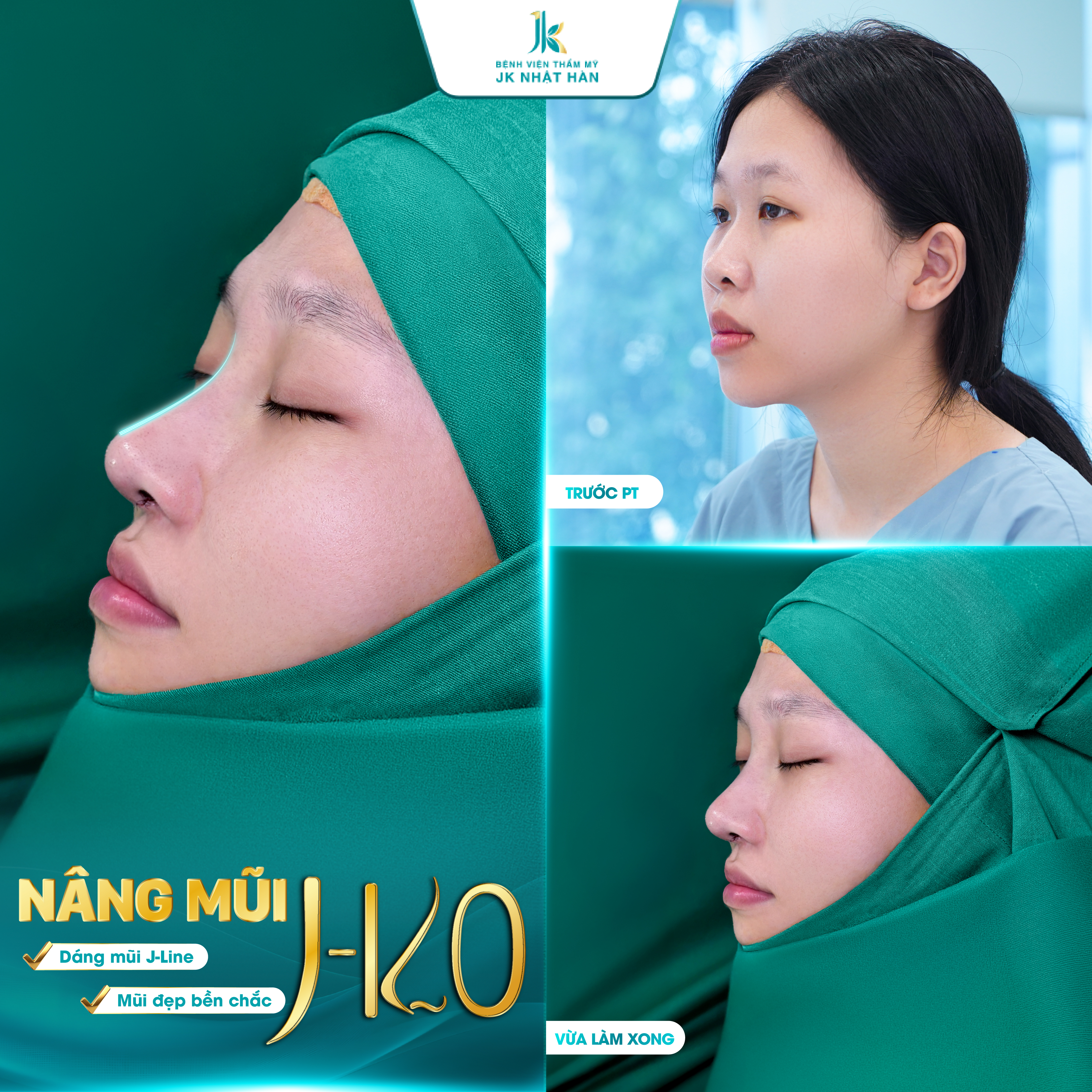 Nâng mũi J-KO giúp khắc phục tình trạng mũi lệch nhân trung