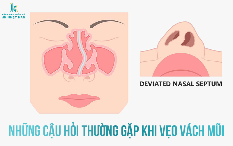 Câu hỏi thường gặp khi vẹo vách ngăn mũi