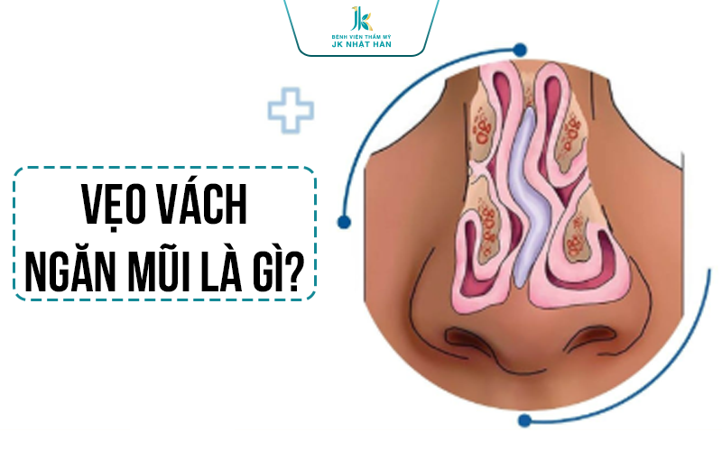 Vẹo vách ngăn mũi là gì?