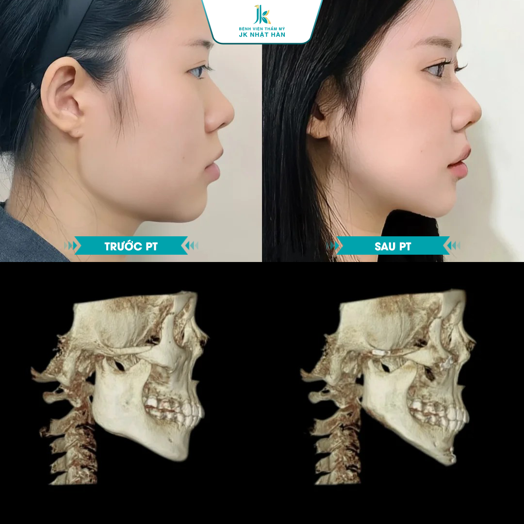 Ai nên thực hiện phẫu thuật gương mặt V Line?