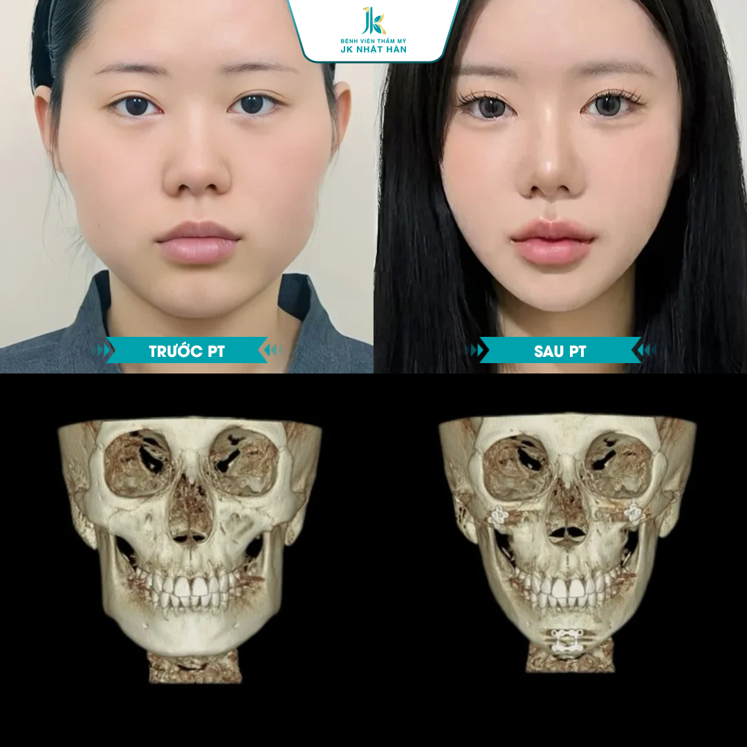 Phẫu thuật gương mặt V Line là gì?