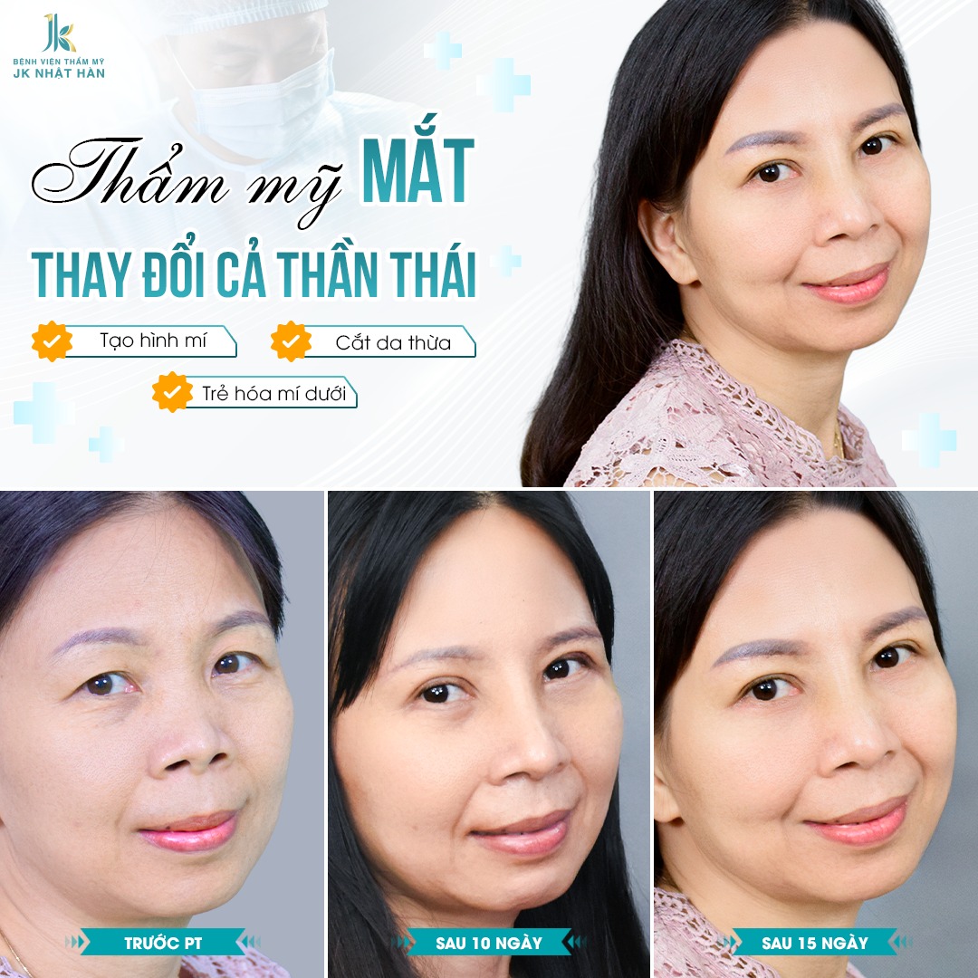 https://benhvienthammyjknhathan.com/cat-mi-sau-6-thang-thay-doi-nhu-the-nao/