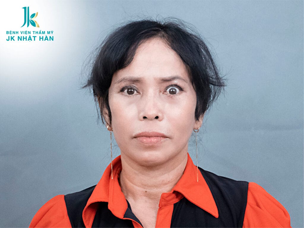 Nguyên nhân gây ra cắt mí mắt bị trợn