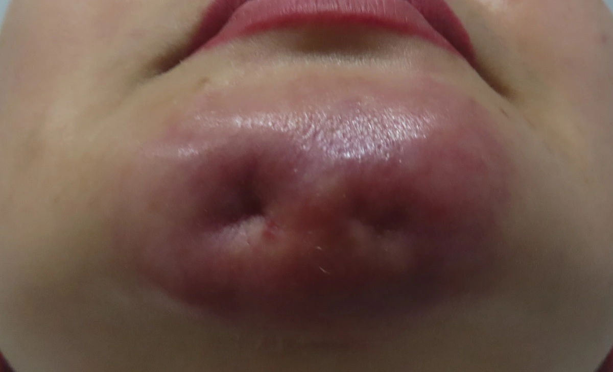 Biến chứng tiêm silicone