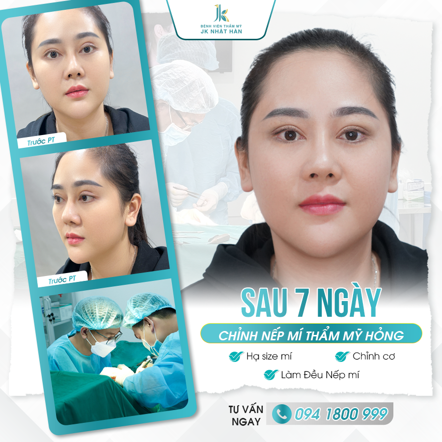 Cắt mí sau 6 tháng thay đổi như thế nào? – 10 thay đổi lớn nhất ai cũng nhận ra