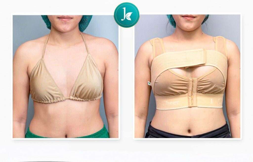 Nâng ngực nội soi Harmonic JK Nhật Hàn