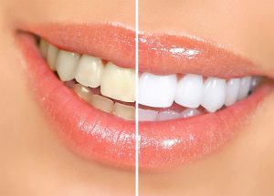 Tẩy trắng răng có tốt không