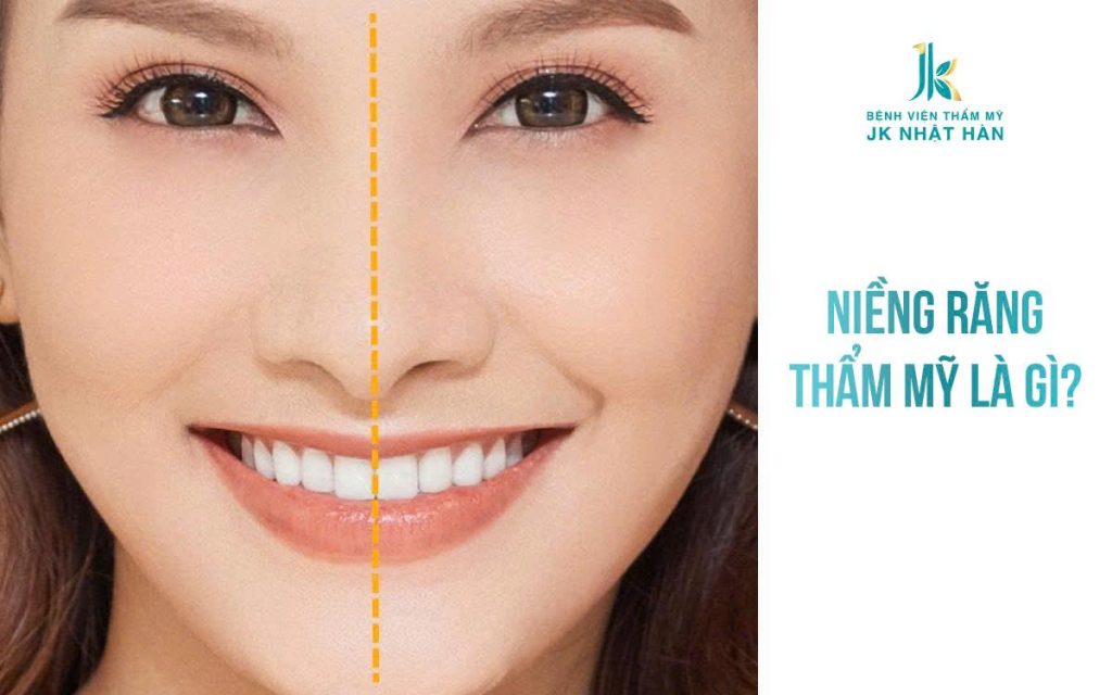 Niềng răng - chỉnh nha