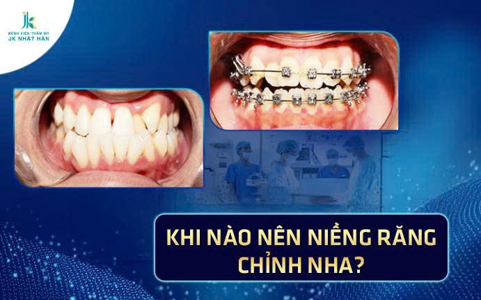 Niềng răng - chỉnh nha