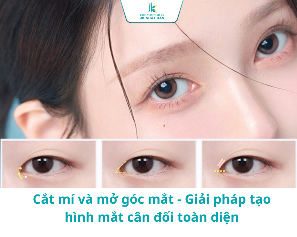 Cắt mí và mở góc mắt - Giải pháp tạo hình mắt cân đối toàn diện