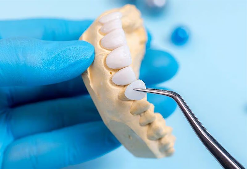 Dán răng sứ veneer lisi jk nhật hàn