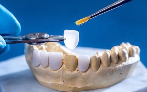 Dán răng sứ veneer lisi jk nhật hàn