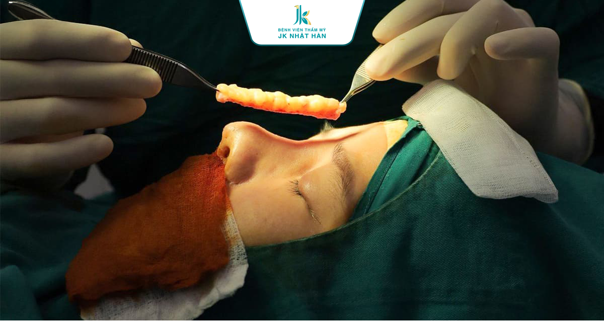 Nâng mũi trung bì