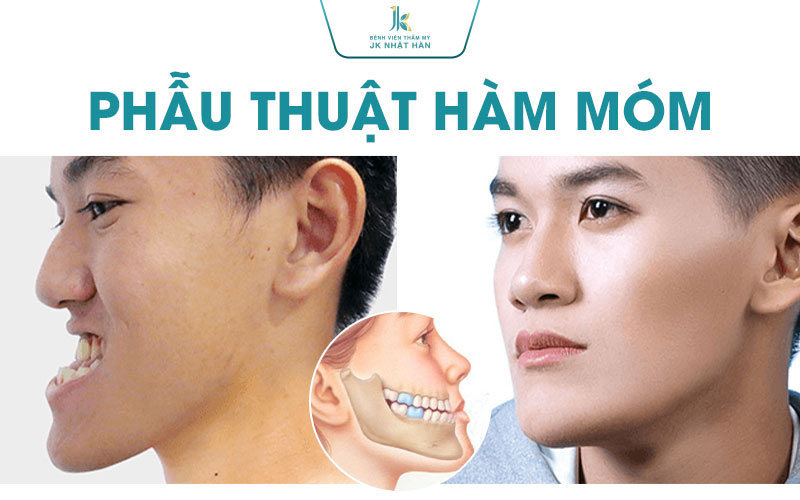 Phẫu thuật hàm móm tại JK Nhật Hàn