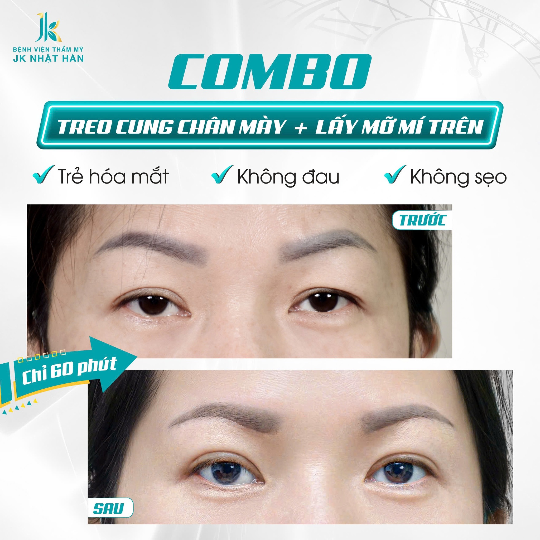 Dịch vụ treo chân mày - Kỹ thuật đặc biệt chỉ có tại JK Nhật Hàn