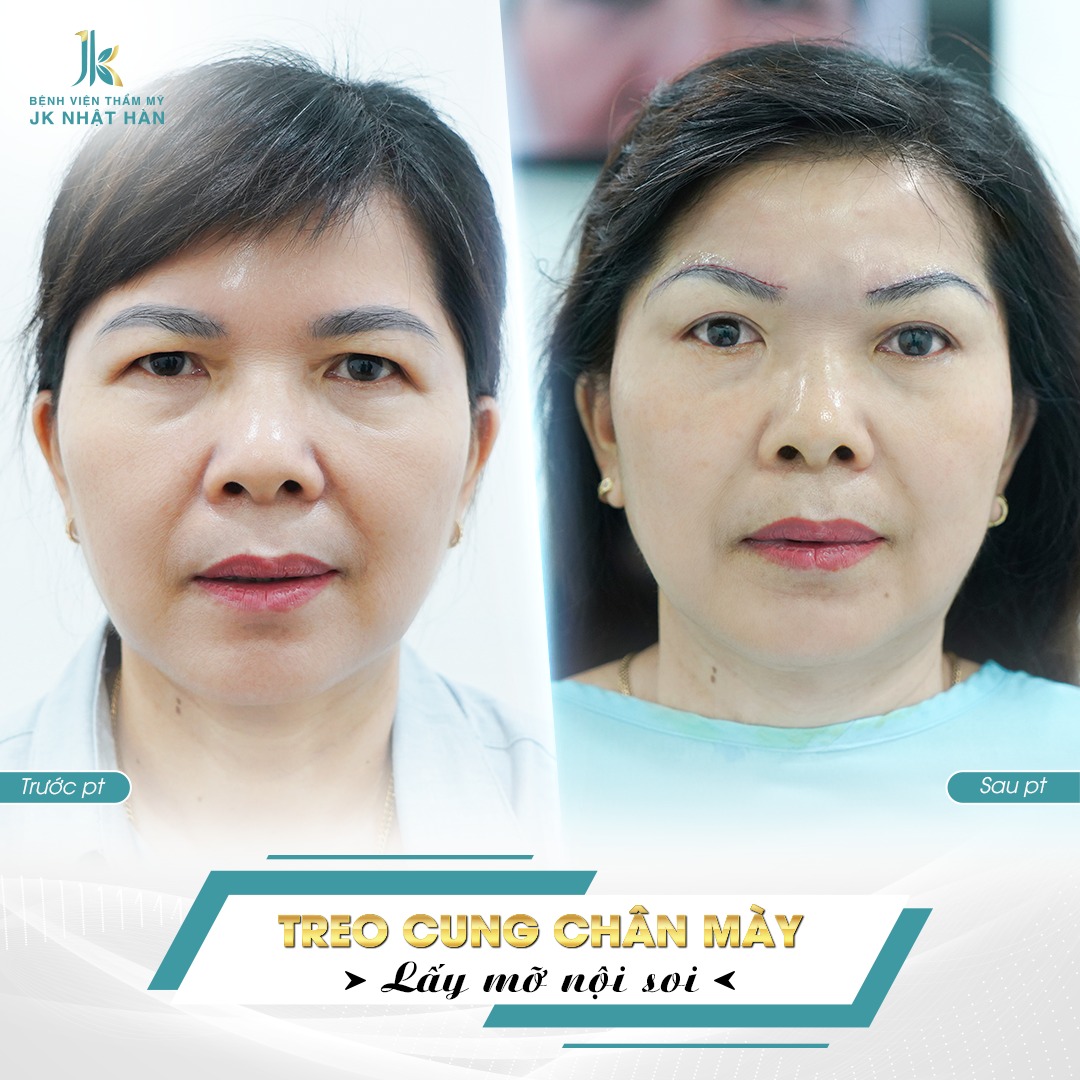 Dịch vụ treo chân mày - Kỹ thuật đặc biệt chỉ có tại JK Nhật Hàn