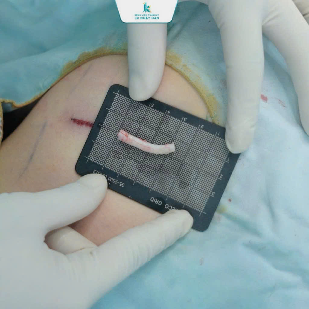 Hình ảnh sụn sườn được lấy để thực hiện nâng mũi