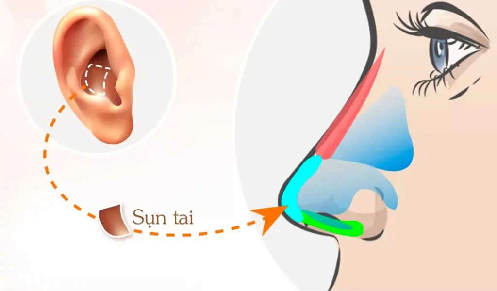Nâng mũi bằng sụn tai