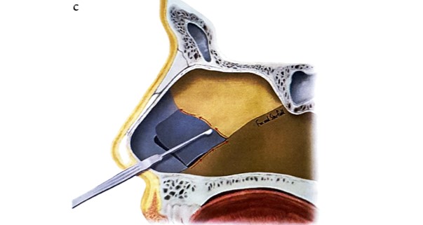 Nâng mũi bằng sụn vách ngăn