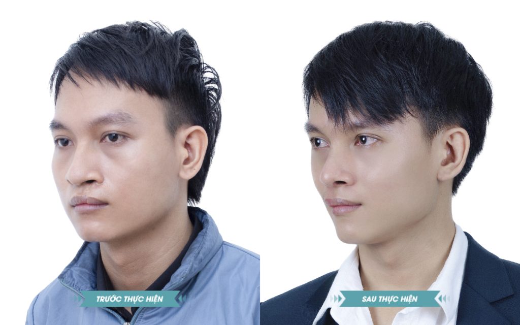 ảnh khách hàng phẫu thuật smhhe tại JK Nhật Hàn 2