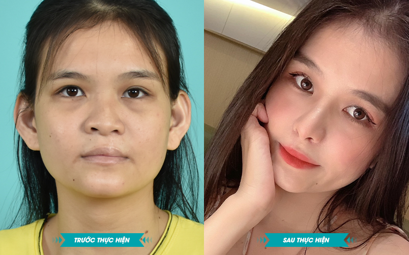 Ảnh khách hàng thẩm mỹ sứt môi hở hàm ếch tại JK Nhật Hàn 1