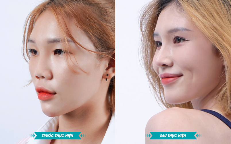 Ảnh khách hàng thẩm mỹ mũi tại JK Nhật Hàn 3