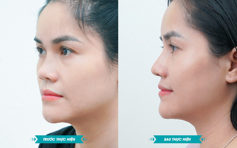 Ảnh khách hàng thẩm mỹ mũi tại JK Nhật Hàn 8