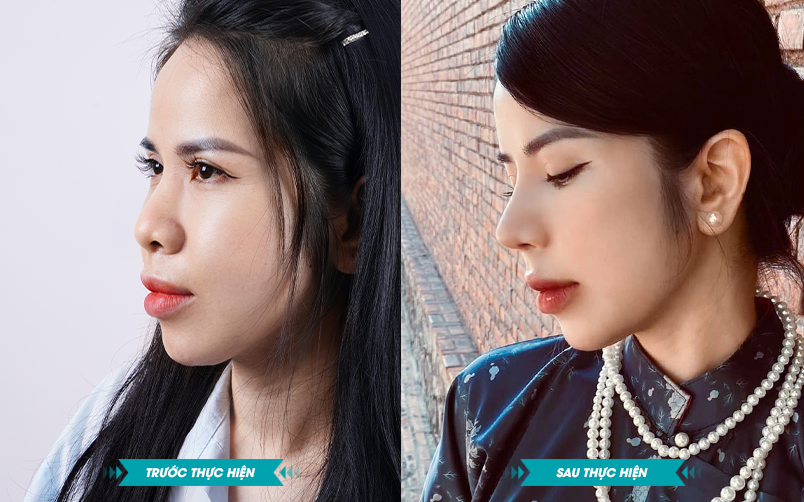 Ảnh khách hàng thẩm mỹ mũi tại JK Nhật Hàn 9