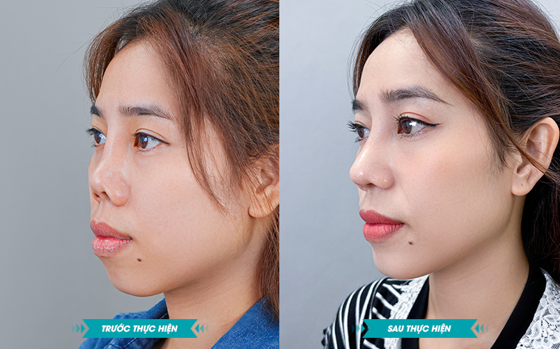 Ảnh khách hàng thẩm mỹ mũi tại JK Nhật Hàn 10