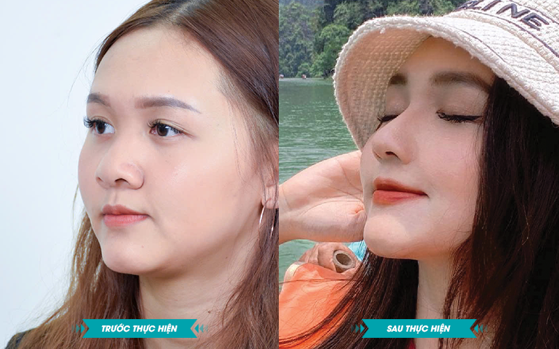 Ảnh khách hàng thẩm mỹ mũi tại JK Nhật Hàn 11