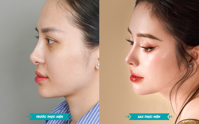 Ảnh khách hàng thẩm mỹ mũi tại JK Nhật Hàn 12