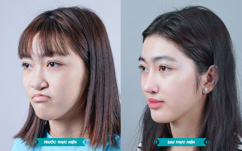 Ảnh khách hàng thẩm mỹ sứt môi hở hàm ếch tại JK Nhật Hàn 2