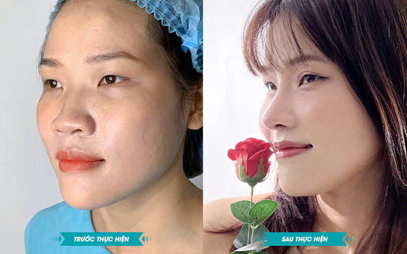 Ảnh khách hàng thẩm mỹ mũi tại JK Nhật Hàn 4