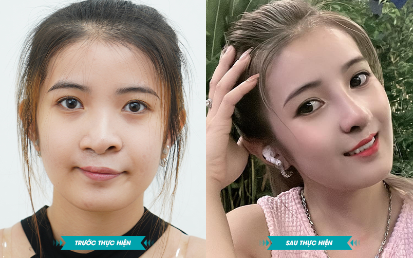 ảnh khách hàng phẫu thuật smhhe tại JK Nhật Hàn 3