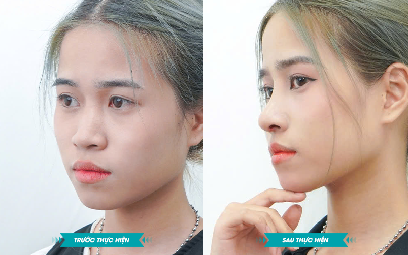 Ảnh khách hàng thẩm mỹ mũi tại JK Nhật Hàn 5