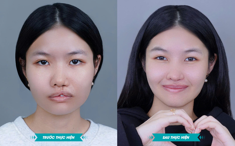 ảnh khách hàng phẫu thuật smhhe tại JK Nhật Hàn 5