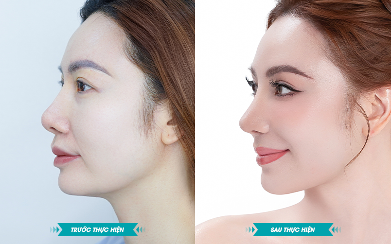 Ảnh khách hàng thẩm mỹ mũi tại JK Nhật Hàn 1